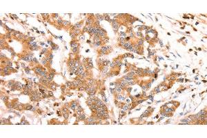 Immunohistochemistry of paraffin-embedded Human colon cancer tissue using CELSR2 Polyclonal Antibody at dilution 1:50 (CELSR2 Antikörper)