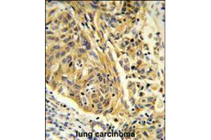 Formalin-fixed and paraffin-embedded human lung carcinoma reacted with CLTA Antibody , which was peroxidase-conjugated to the secondary antibody, followed by DAB staining. (CLTA Antikörper  (AA 99-127))
