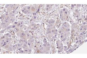ABIN6273954 at 1/100 staining Human liver cancer tissue by IHC-P. (OR2A12 Antikörper  (C-Term))