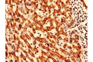 Immunohistochemistry analysis of human liver cancer using ABIN7171128 at dilution of 1:100 (SYNJ2BP Antikörper  (AA 1-117))