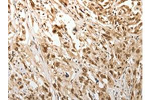 The image on the left is immunohistochemistry of paraffin-embedded Human esophagus cancer tissue using ABIN7189683(ADIPOR2 Antibody) at dilution 1/15, on the right is treated with synthetic peptide. (Adiponectin Receptor 2 Antikörper)