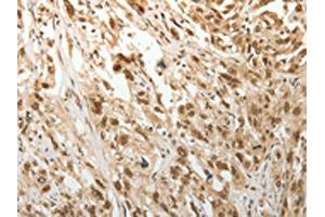 The image on the left is immunohistochemistry of paraffin-embedded Human esophagus cancer tissue using ABIN7189683(ADIPOR2 Antibody) at dilution 1/15, on the right is treated with synthetic peptide. (Adiponectin Receptor 2 Antikörper)