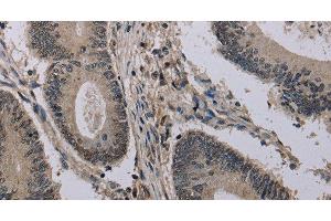 Immunohistochemistry of paraffin-embedded Human colon cancer using HIST1H2AH Polyclonal Antibody at dilution of 1:40 (HIST1H2AH Antikörper)