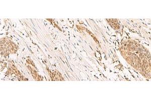 Immunohistochemistry of paraffin-embedded Human esophagus cancer tissue using POP4 Polyclonal Antibody at dilution of 1:65(x200) (RPP29 Antikörper)