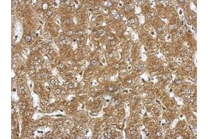 IHC-P Image Immunohistochemical analysis of paraffin-embedded human hepatoma, using NDST3, antibody at 1:500 dilution.