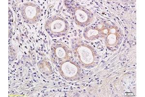 Formalin-fixed and paraffin embedded human rhinopolypus labeled with Rabbit Anti IL-23 Polyclonal Antibody, Unconjugated (ABIN673179) at 1:200 followed by conjugation to the secondary antibody and DAB staining (IL23 Antikörper  (AA 101-196))