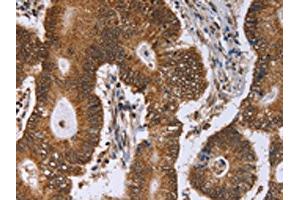The image on the left is immunohistochemistry of paraffin-embedded Human colon cancer tissue using ABIN7129394(ERCC6L Antibody) at dilution 1/30, on the right is treated with fusion protein. (ERCC6L Antikörper)