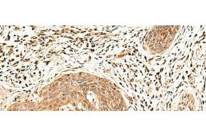 Immunohistochemistry of paraffin-embedded Human esophagus cancer tissue using LDHA Polyclonal Antibody at dilution of 1:25(x200) (Lactate Dehydrogenase A Antikörper)