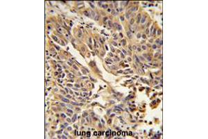 Formalin-fixed and paraffin-embedded human lung carcinoma reacted with JUP Antibody , which was peroxidase-conjugated to the secondary antibody, followed by DAB staining. (JUP Antikörper  (C-Term))