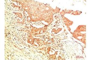 Immunohistochemical analysis of paraffin-embedded Human Breast Carcinoma Tissue using Acetyl P53(K382) Mouse mAb diluted at 1:200. (p53 Antikörper  (acLys382))