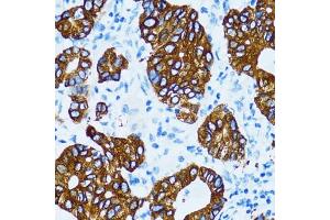 Immunohistochemistry of paraffin-embedded human gastric cancer using Cathepsin E (CTSE) antibody (ABIN3016440, ABIN3016441, ABIN3016442 and ABIN6219747) at dilution of 1:100 (40x lens). (Cathepsin E Antikörper)