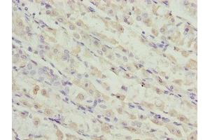 Immunohistochemistry of paraffin-embedded human gastric cancer using ABIN7173119 at dilution of 1:100 (TMEM19 Antikörper  (AA 105-217))