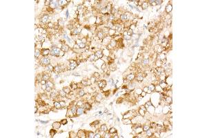 Immunohistochemistry of paraffin-embedded human liver cancer using PFKP antibody (ABIN7269309) at dilution of 1:100 (40x lens). (PFKP Antikörper)