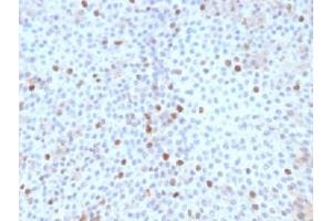 IHC testing of FFPE human bladder carcinoma with Topoisomerase II alpha antibody (clone TOP2A/1361). (Topoisomerase II alpha Antikörper  (AA 1352-1493))