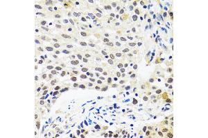 Immunohistochemistry of paraffin-embedded human lung cancer using MYOG antibody.