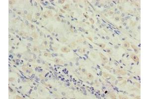 Immunohistochemistry of paraffin-embedded human gastric cancer using ABIN7142334 at dilution of 1:100 (OXSM Antikörper  (AA 78-345))