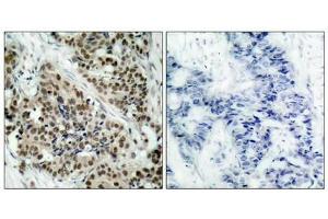 Immunohistochemical analysis of paraffin-embedded human breast carcinoma tissue using FKHR (Phospho-Ser256) Antibody (left) or the same antibody preincubated with blocking peptide (right). (FOXO1 Antikörper  (pSer256))