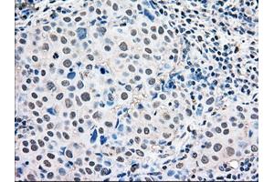 Immunohistochemical staining of paraffin-embedded Adenocarcinoma of ovary tissue using anti-MAPK1mouse monoclonal antibody. (ERK2 Antikörper)