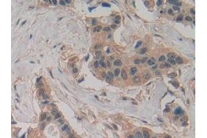Detection of Slit2 in Human Breast cancer Tissue using Polyclonal Antibody to Slit Homolog 2 (Slit2) (SLIT2 Antikörper  (AA 1416-1528))