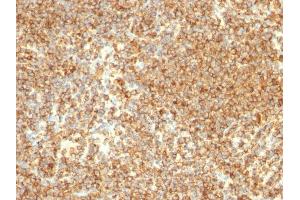 Formalin-fixed, paraffin-embedded human Lymphoma stained with CD20 Mouse Monoclonal Antibody (L26). (CD20 Antikörper)