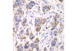 Immunohistochemistry of paraffin-embedded human esophageal cancer using ALDH2 antibody (ABIN5970568) at dilution of 1/100 (40x lens).