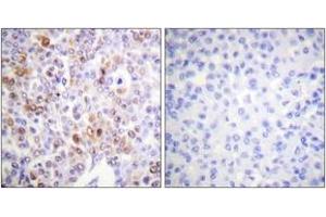 Immunohistochemistry analysis of paraffin-embedded human breast carcinoma tissue, using Histone H4 (Acetyl-Lys16) Antibody. (Histone H4 Antikörper  (acLys16))