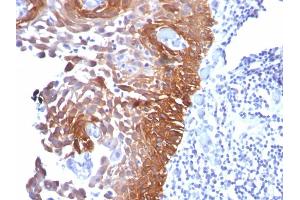 Formalin-fixed, paraffin-embedded human Cervical Carcinoma stained with CK17 Mouse Monoclonal Antibody (E3). (KRT17 Antikörper)