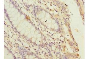 Immunohistochemistry of paraffin-embedded human colon cancer using ABIN7169258 at dilution of 1:100 (PPP2R5C Antikörper  (Regulatory Subunit Gamma))