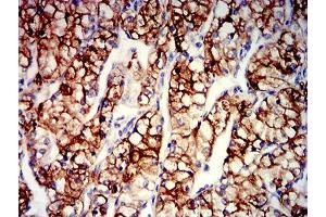 Immunohistochemical analysis of paraffin-embedded renal cancer tissues using CD203C mouse mAb with DAB staining. (ENPP3 Antikörper  (AA 45-163))