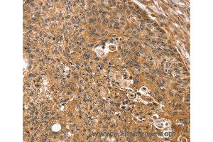 Immunohistochemistry of Human breast cancer using SSX2IP Polyclonal Antibody at dilution of 1:35 (SSX2IP Antikörper)