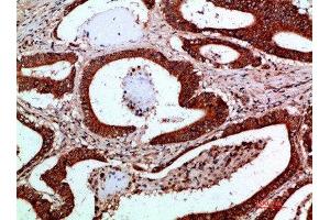 Immunohistochemical analysis of paraffin-embedded human-colon-cancer, antibody was diluted at 1:200