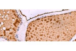 Immunohistochemistry of paraffin-embedded Human thyroid cancer tissue using ASTE1 Polyclonal Antibody at dilution of 1:50(x200) (ASTE1 Antikörper)