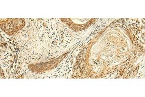Immunohistochemistry of paraffin-embedded Human esophagus cancer tissue using ARL4D Polyclonal Antibody at dilution of 1:50(x200)