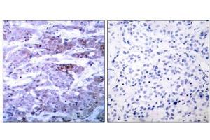 Immunohistochemical analysis of paraffin- embedded human breast carcinoma tissue using BAD (Ab-112) antibody (E021062). (BAD Antikörper)