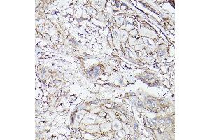 Immunohistochemistry of paraffin-embedded human esophageal cancer using MCT4/SLC16 Rabbit pAb (ABIN6129472, ABIN6147859, ABIN6147860 and ABIN6214836) at dilution of 1:100 (40x lens).