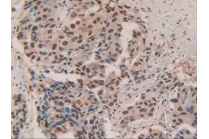 IHC-P analysis of Human Breast Cancer Tissue, with DAB staining. (HDGF Antikörper  (AA 10-240))