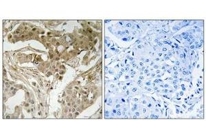 Immunohistochemical analysis of paraffin-embedded human breast carcinoma tissue using FOS (Phospho-Thr232) antibody (left)or the same antibody preincubated with blocking peptide (right). (c-FOS Antikörper  (pThr232))