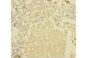 Immunohistochemistry of paraffin-embedded human lung cancer using ABIN7160909 at dilution of 1:100 (NDUFA6 Antikörper  (AA 27-154))