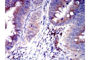Immunohistochemical analysis of paraffin-embedded rectum cancer tissues using CD327 mouse mAb with DAB staining. (SIGLEC6 Antikörper  (AA 27-347))