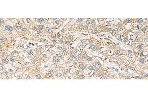 Immunohistochemistry of paraffin-embedded Human liver cancer tissue using LRRC28 Polyclonal Antibody at dilution of 1:60(x200) (LRRC28 Antikörper)