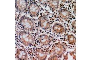 Immunohistochemical analysis of PIR121 staining in human colon cancer formalin fixed paraffin embedded tissue section.