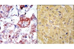 (LEFT)Formalin-fixed and paraffin-embedded human cancer tissue reacted with the primary antibody, which was peroxidase-conjugated to the secondary antibody, followed by AEC staining. (ILK Antikörper  (N-Term))