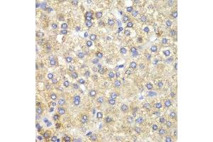 Immunohistochemistry of paraffin-embedded human liver cancer using HADH antibody. (HADH Antikörper  (AA 1-314))