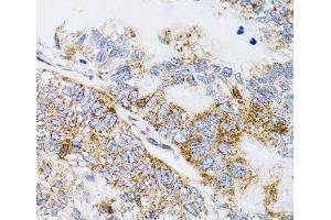 Immunohistochemistry of paraffin-embedded Human gastric cancer using PDYN Polyclonal Antibody at dilution of 1:100 (40x lens). (PDYN Antikörper)