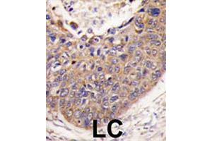 Formalin-fixed and paraffin-embedded human lung carcinoma tissue reacted with FXN polyclonal antibody  , which was peroxidase-conjugated to the secondary antibody, followed by DAB staining. (Frataxin Antikörper  (C-Term))