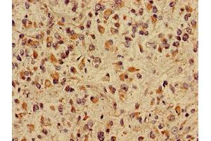 Immunohistochemistry of paraffin-embedded human glioma using ABIN7149048 at dilution of 1:100