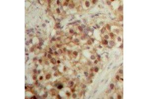 Immunohistochemical analysis of LONP2 staining in human breast cancer formalin fixed paraffin embedded tissue section. (LONP2 Antikörper  (C-Term))