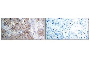 Immunohistochemical analysis of paraffin- embedded human breast carcinoma tissue using IGF-1R (phospho-Tyr1161) antibody (E011087). (IGF1R Antikörper  (pTyr1161))