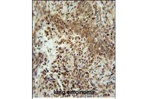 ZN Antibody (Center) (ABIN654509 and ABIN2844236) immunohistochemistry analysis in formalin fixed and paraffin embedded human lung carcinoma followed by peroxidase conjugation of the secondary antibody and DAB staining. (ZNF667 Antikörper  (AA 303-331))
