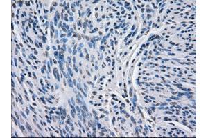 Immunohistochemical staining of paraffin-embedded endometrium tissue using anti-BCKDK mouse monoclonal antibody. (BCKDK Antikörper)